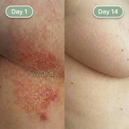 Novalys™ Intertrigo Relief Cream